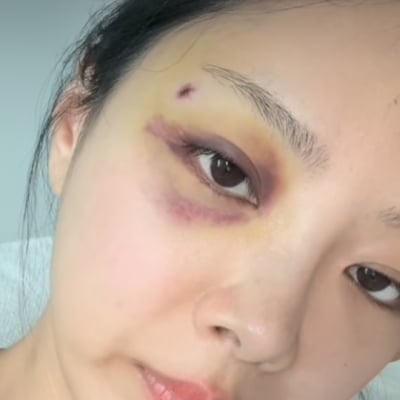 10기 옥순, 재혼 앞두고 눈에 시퍼런 멍…시술은 아닌 것같은데