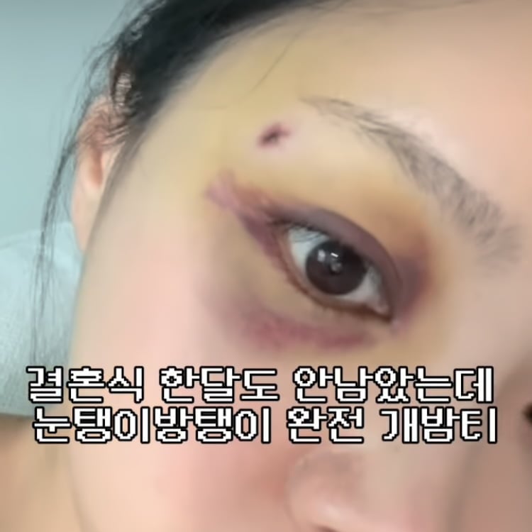 10기 옥순, 재혼 앞두고 눈에 시퍼런 멍…시술은 아닌 것같은데