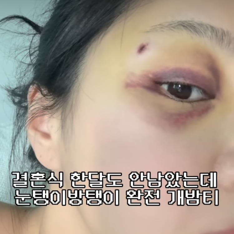 10기 옥순, 재혼 앞두고 눈에 시퍼런 멍…시술은 아닌 것같은데