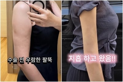 "1주차에 멍 빠지고, 2주차에 낚시"…1700cc 팔뚝 지흡한 김하영, 전후 공개