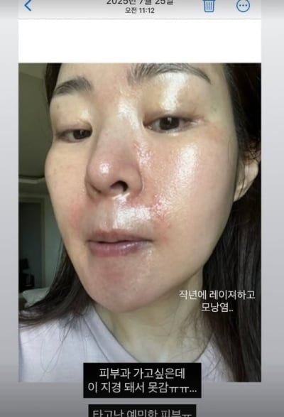 미자, 모공 레이저 시술했다가 '부작용' 뒤늦게 알렸다…"다신 안 해"