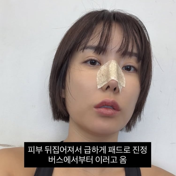 ‘돌싱’ 이소라, 인중에도 주사 맞더니…코수술 또 한줄