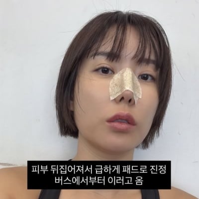 ‘돌싱’ 이소라, 인중에도 주사 맞더니…코수술 또 한줄
