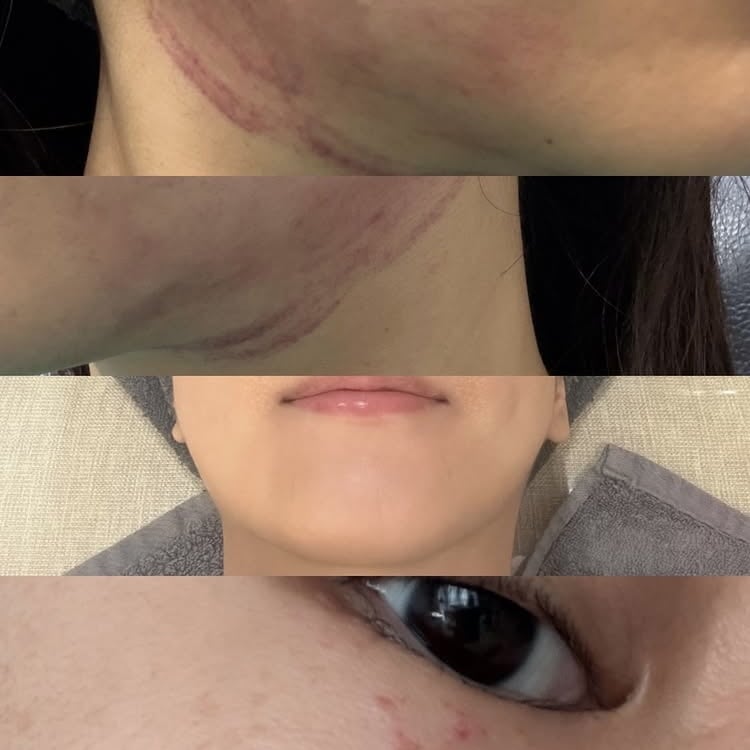 “팔자주름과 심부볼이 고민”…22기 옥순, 피부과 VIP로서 시술 정보 공개