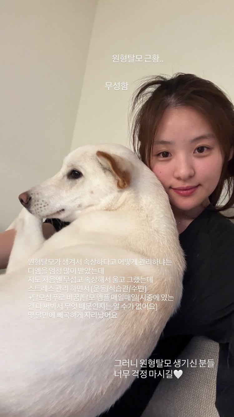 2000년생 김지민, 머리에 구멍생겼다…원형탈모 고백하고 9개월 흘러