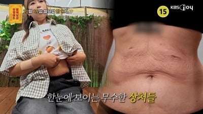 6개월 만에 40kg 빠졌다…알고보니 수술 후유증, "할머니 몸 같아" ('물어보살')