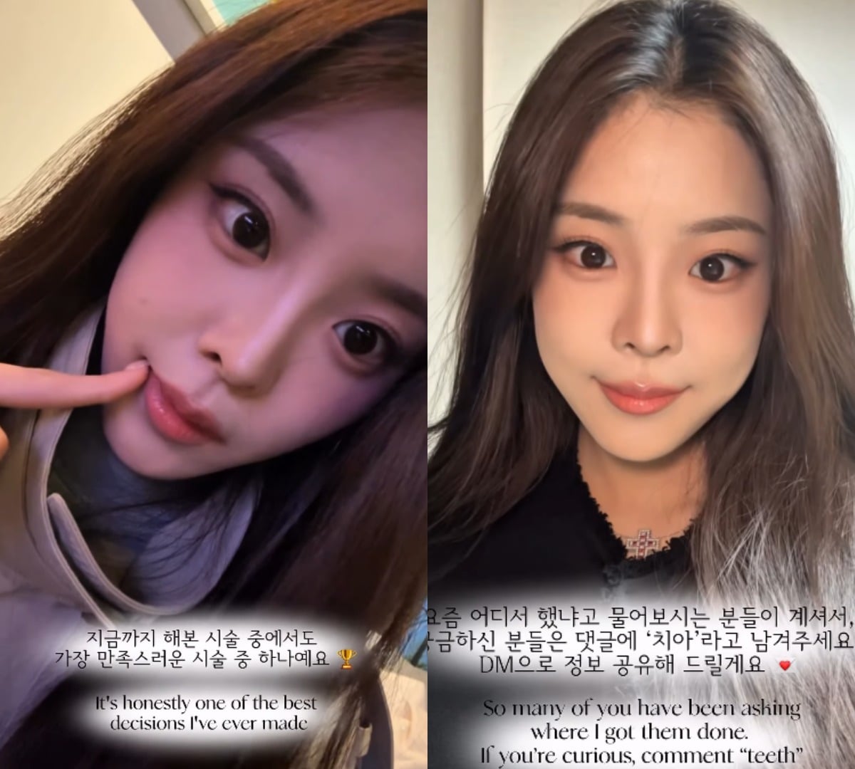 우서윤이 치아 시술 사실을 털어놨다. / 사진=우서윤 SNS 